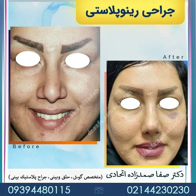 نمونه کار جراحی بینی